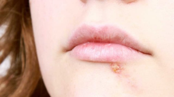 Ba mẹ cần lưu ý ngay những biện pháp phòng ngừa sùi mào gà ở trẻ em