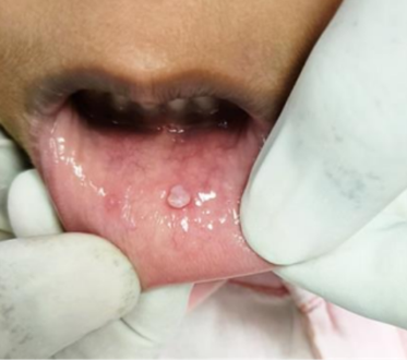 Biểu hiện lâm sàng của mụn cóc trong miệng ở môi dưới