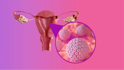 HPV 16 – nguyên nhân của khoảng 60% ung thư tế bào vảy cổ tử cung