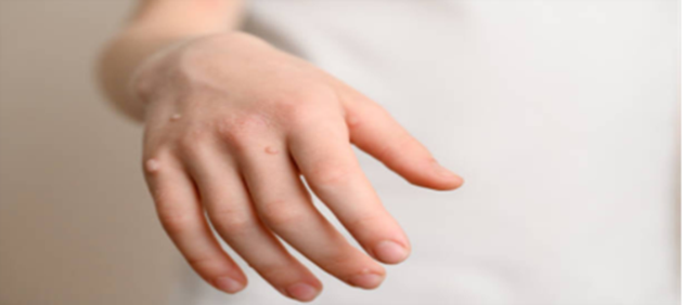 HPV là nguyên nhân chủ yếu gây ra sùi mào gà