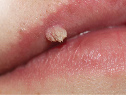 Sùi mào gà gây ra bởi nhiều týp HPV, trong đó thường gặp nhất là týp 6 và 11